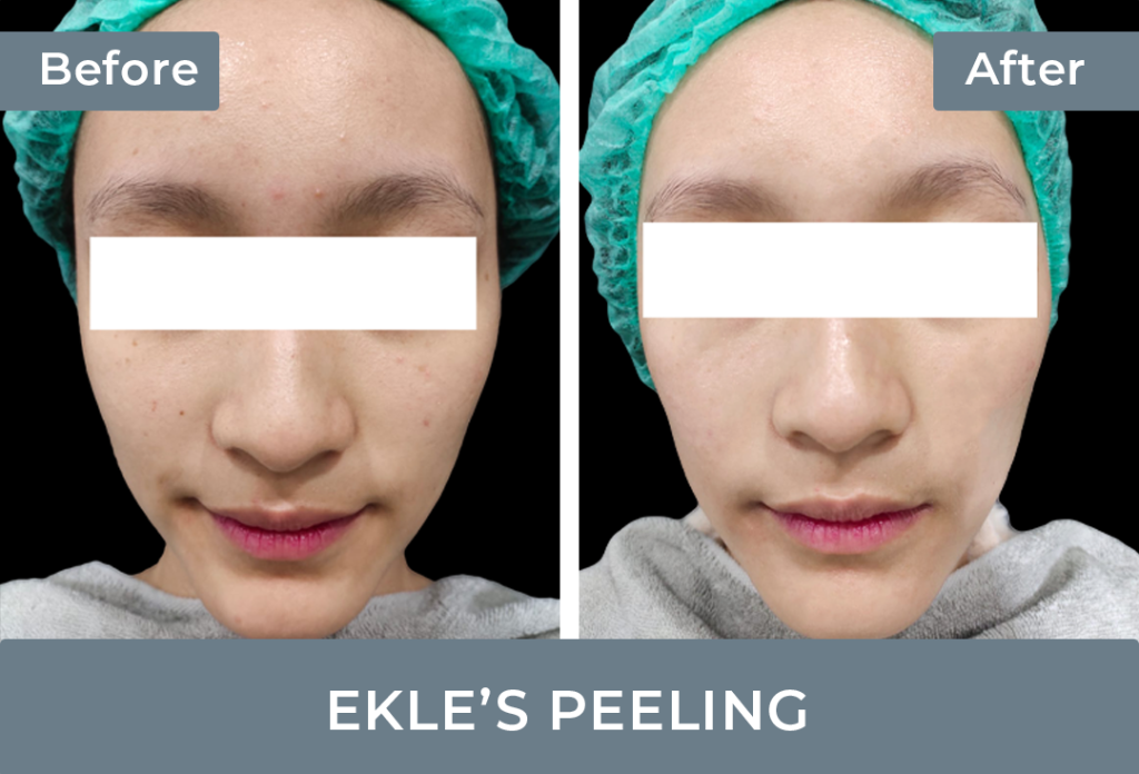 before-after-peeling.png
